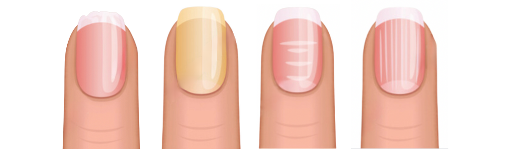 Les problèmes d’ongles : comprendre l’état de vos ongles pour mieux les soigner